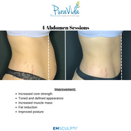 EMSCULPT NEO Body Sculpting Package – 4 Sessions (Any Area) + 2 Bonus Sessions