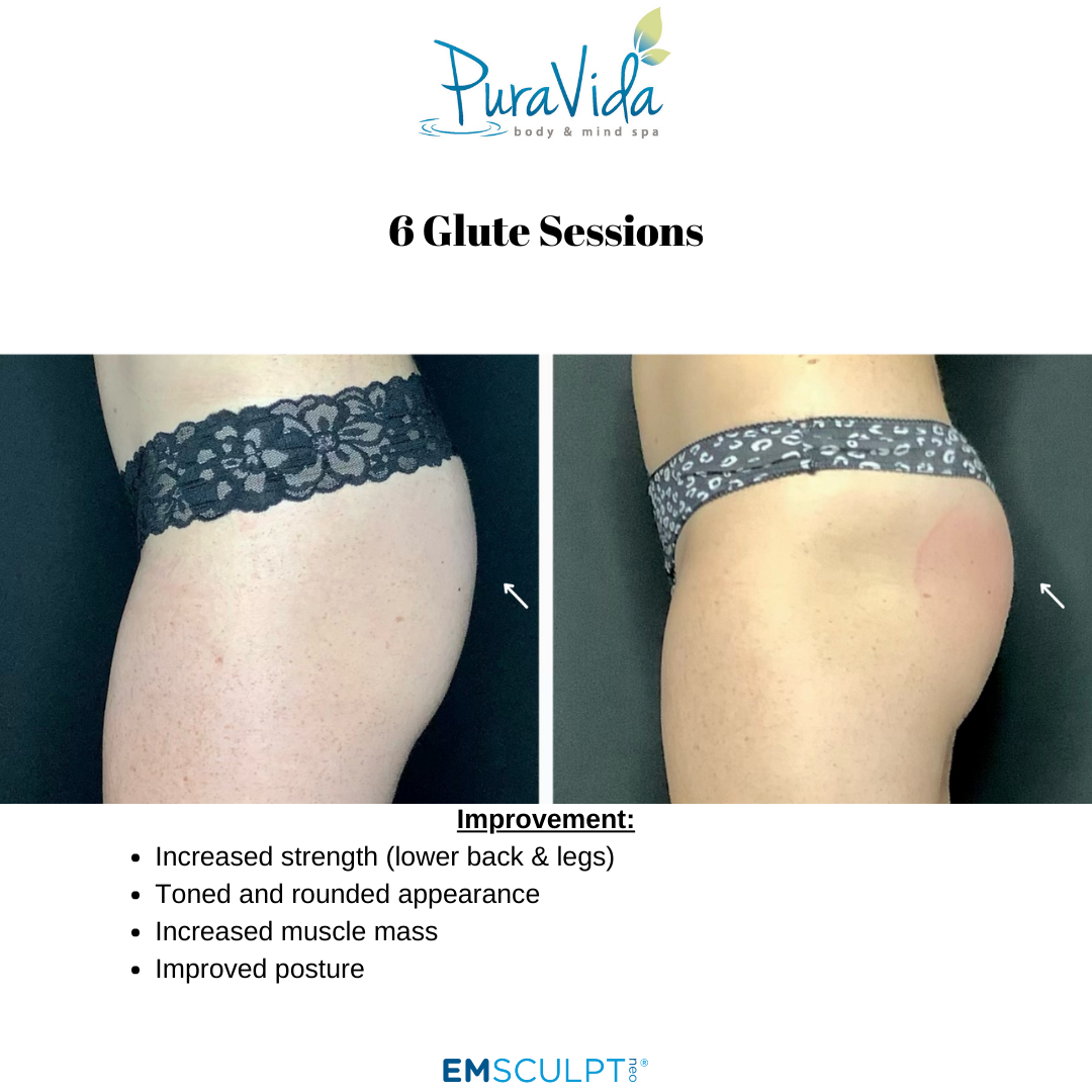 Emsculpt Neo® – Sculpt, Tone & Transform Your Body