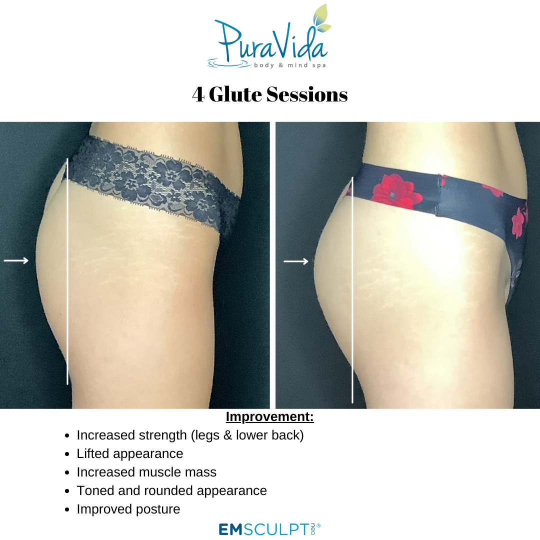 Emsculpt Neo® – Sculpt, Tone & Transform Your Body