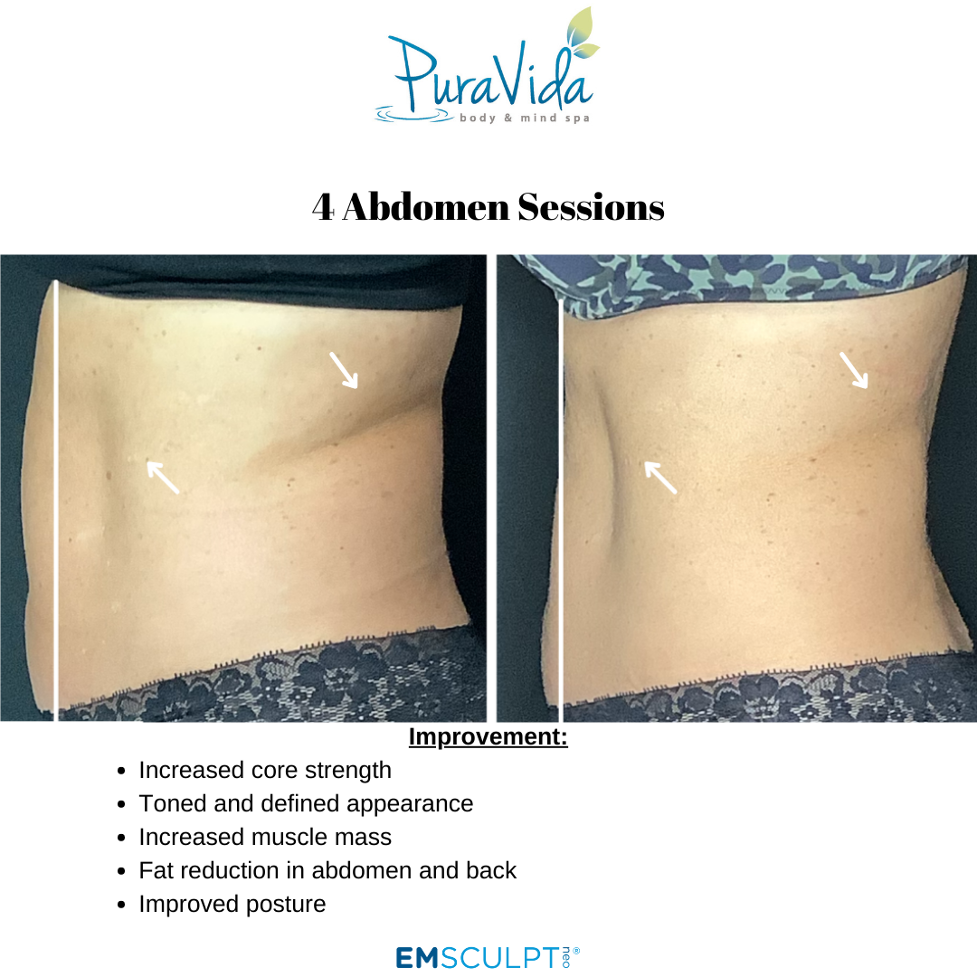 Emsculpt Neo® – Sculpt, Tone & Transform Your Body