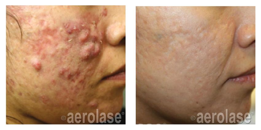Aerolase Neo Elite®