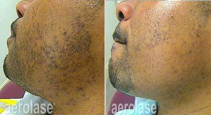 Aerolase Neo Elite®