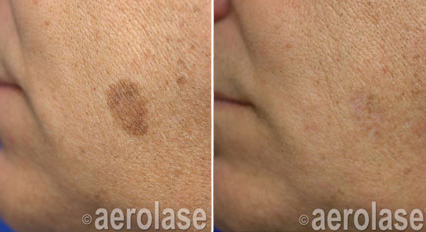 Aerolase Neo Elite®
