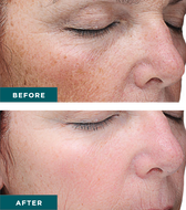 VI PEEL PRECISION PLUS