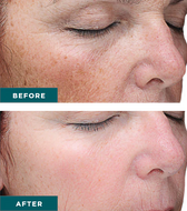 VI Peel- Series of 3