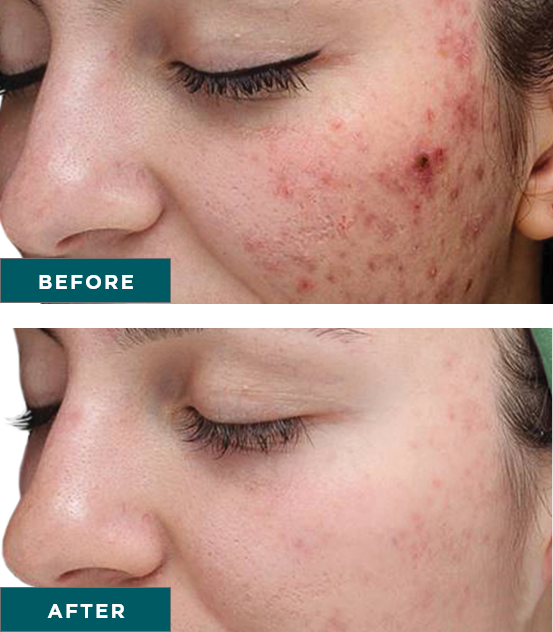VI PEEL PURIFY WITH PRECISION PLUS + FREE GLUTATHIONE- SERIES OF 3