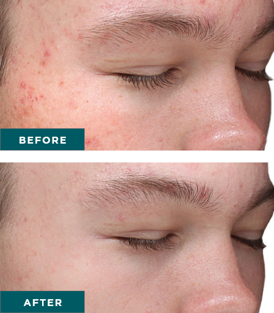 VI PEEL PURIFY+ FREE GLUTATHIONE- SERIES OF 3