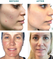 VI PEEL + TOX BUNDLE