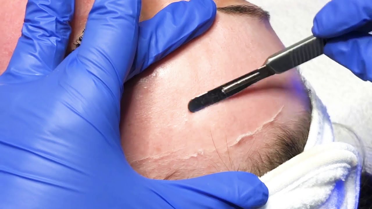 DiamondGlow + Dermaplaning